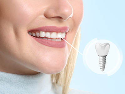 Lake Street Dental | Crowns amp Caps, Veneers and Oral Exams